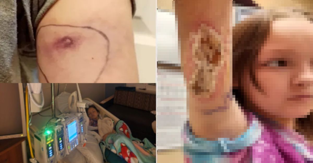 Garota acha que etiqueta da roupa a machucou, mas quase perde verde a vida quando os médicos ignoraram os sintomas da picada de um animal peçonhento 31 FN+