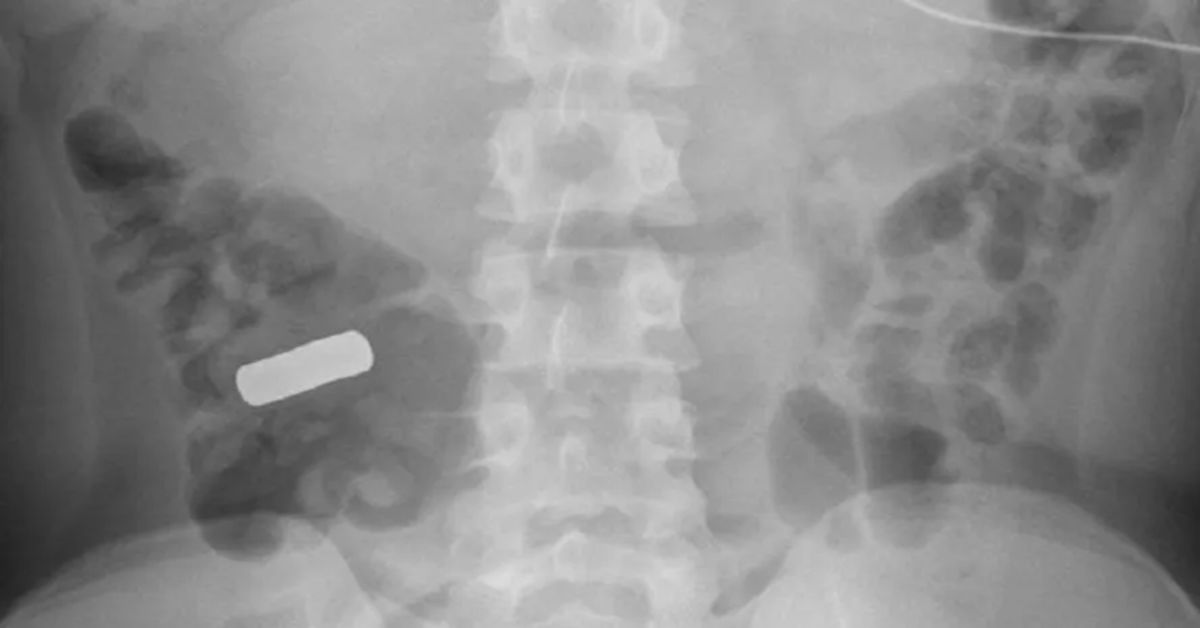 Adolescente vai à hospital com dores abdominais e médicos ficam assombrados com o que encontraram no intestino do paciente: ‘Dezenas’ 31 FN+