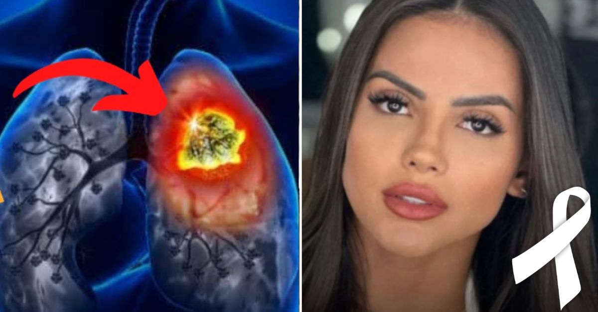 O que é e quais são os sintomas desta condição que levou Luana Andrade ao óbito após lipoaspiração 31 FN+