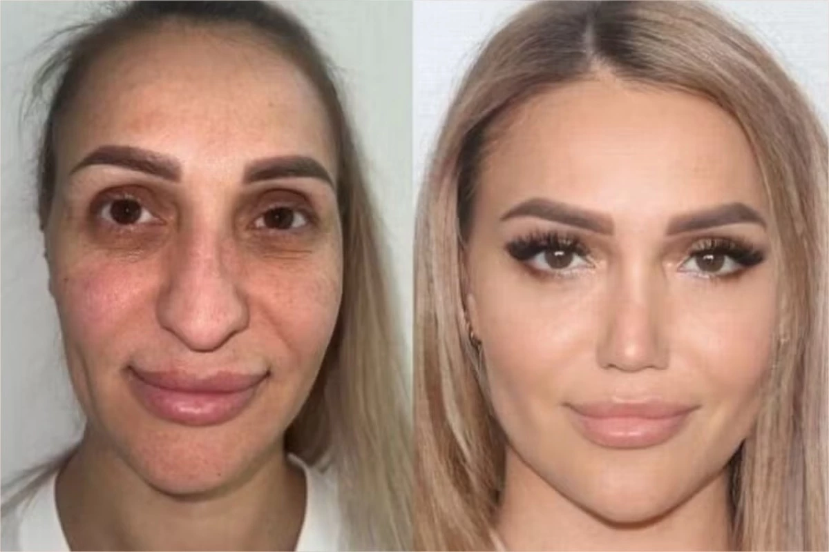 Mulher muda o rosto totalmente com cirurgia plástica e deixa os internautas perplexos 31 1News Brasil