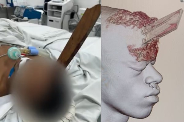 Pedreiro e socorrido em estado grave apos ter cranio perfurado
