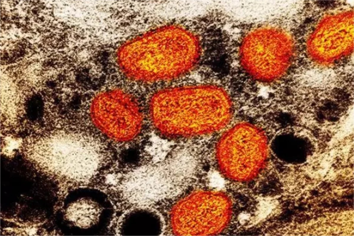 Mpox, Conhecida como Varíola do Macaco, Leva OMS a Declarar Emergência Global... 31 Mpox Conhecida como Variola do Macaco Leva OMS a Declarar.webp.jpeg
