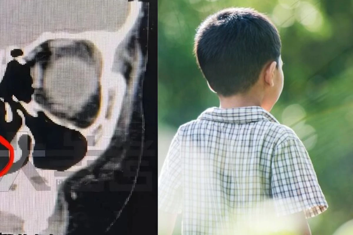 Menino sente cheiro estranho por anos e só depois descobrem objeto no nariz; especialistas dão alerta 31 1News Brasil