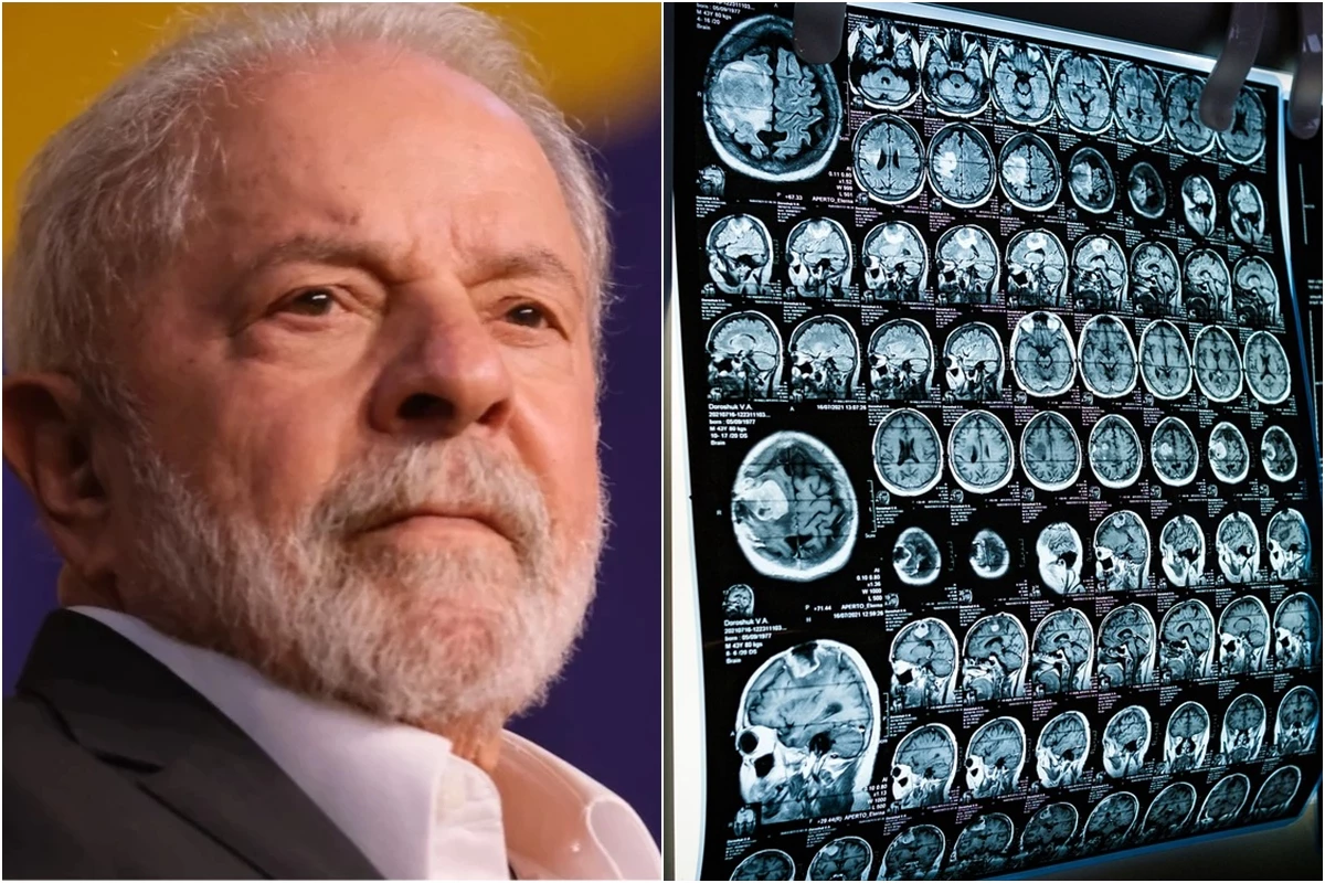 O que é trepanação? Lula passou por procedimento em hospital de São Paulo 31 1News Brasil