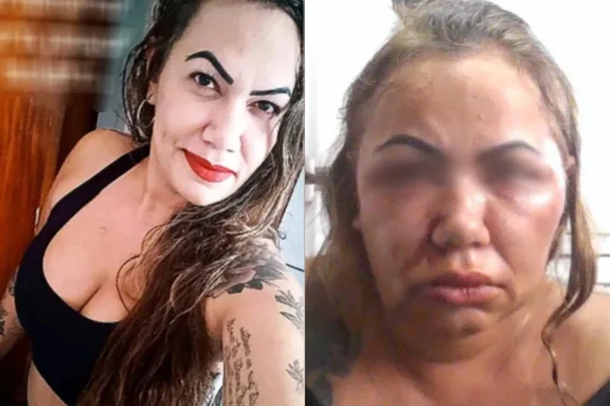 Agredida por duas horas pelo ex, professora que perdeu parte da audição só consegue dormir se for com remédios 34 1News Brasil