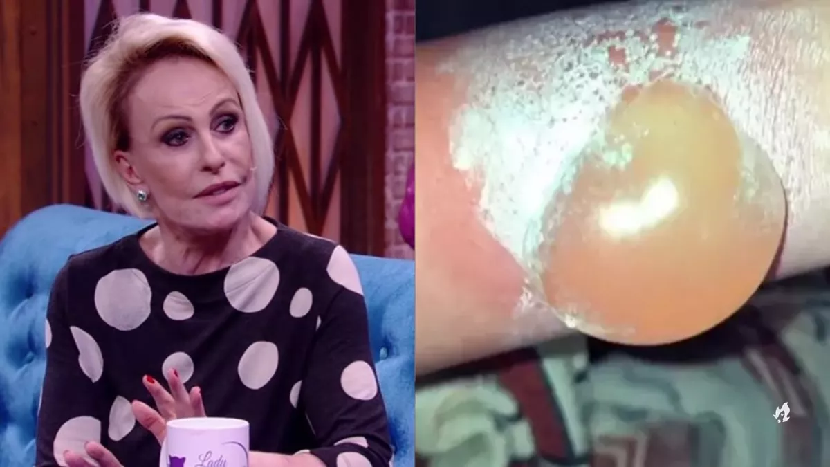 Ana Maria Braga assusta ao mostrar bolha provocada em.webp