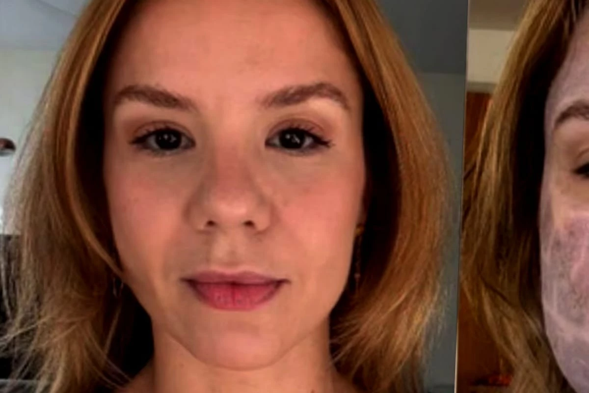 Bruna Paludetti expõe rosto desfigurado após procedimento estético mal-sucedido 34 1News Brasil