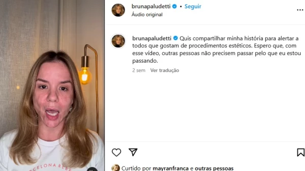 Bruna Paludetti expoe rosto desfigurado apos procedimento estetico mal sucedido