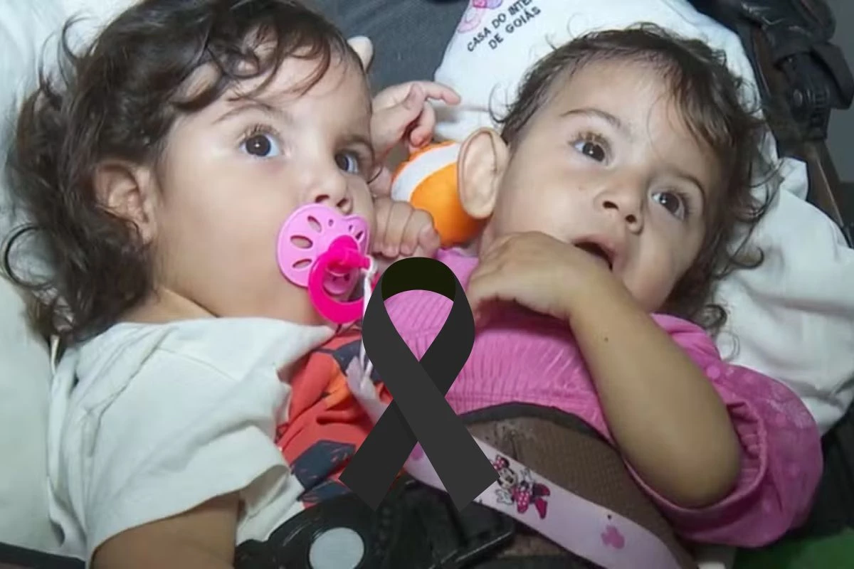Cirurgia histórica em gêmeas siamesas tem desfecho triste: uma não resiste 31 1News Brasil