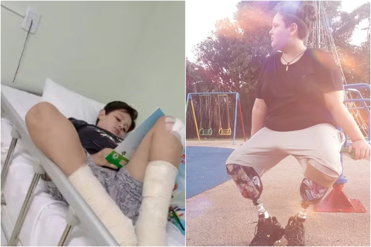 Menino do Paraná cai de skate, rala o joelho e amputa as pernas por causa de infecção 31 1News Brasil