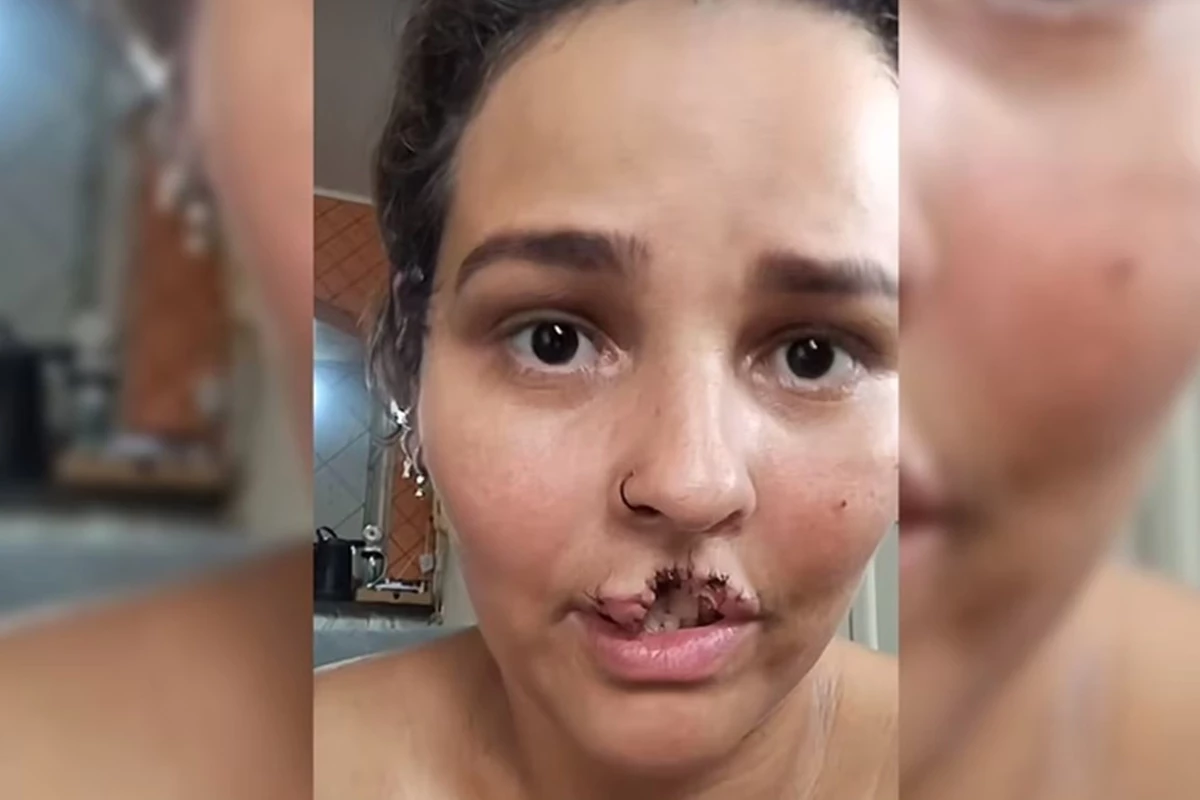 Mulher tem lábio arrancado por cachorro chow-chow; marido optou pela eutanásia do animal 31 1News Brasil