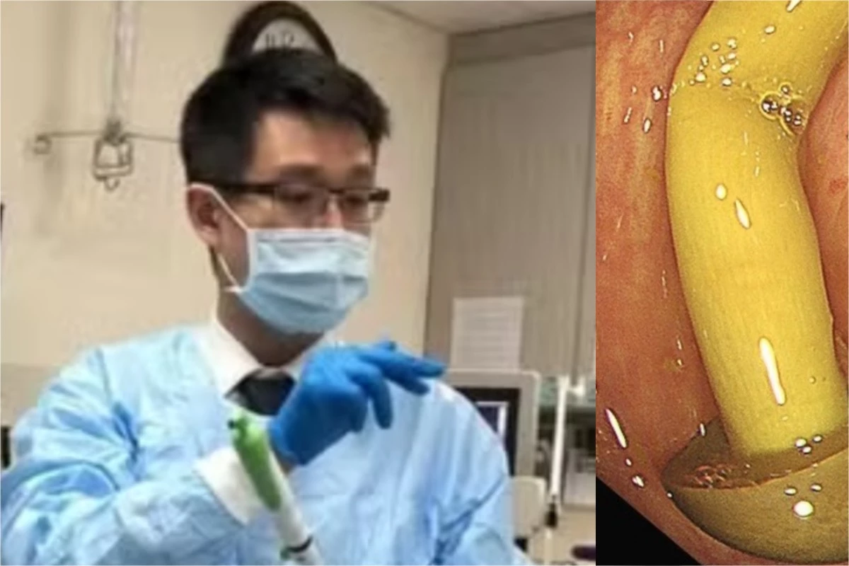 Incrível! Durante exame, médico percebe que cogumelo cresceu dentro do intestino de um homem 34 1News Brasil