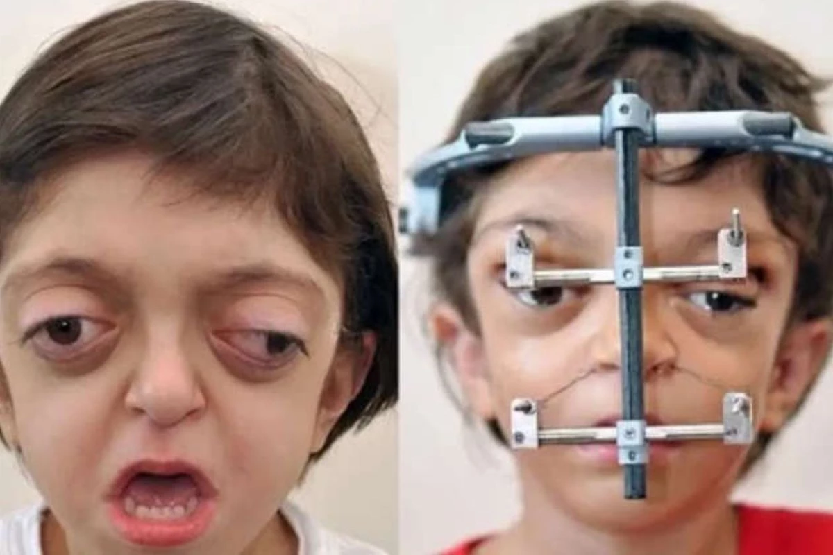 Menino com síndrome rara passa por cirurgia inovadora e recuperação é um sucesso 34 1News Brasil