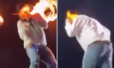 Cantor sertanejo Leo mostra como ficou seu rosto apos.webp