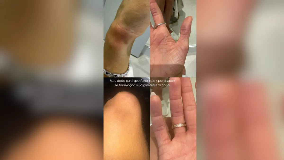 Ex namorada acusa MC Brisola de agressao e mostra lesoes.webp