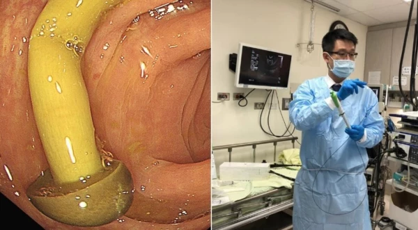 Incrivel Durante exame medico percebe que cogumelo cresceu dentro do