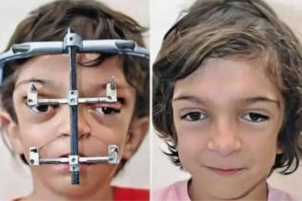 Menino com sindrome rara passa por cirurgia inovadora e recuperacao